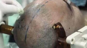 لأول مرة.. الصين تجرب شريحة دماغية للتحكم البشري بواسطة الذكاء الاصطناعي