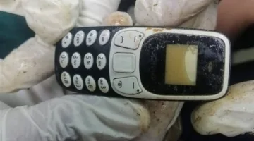إزالة هاتف محمول من بطن مريض بعد عامين من ابتلاعه في مستشفى أسيوط