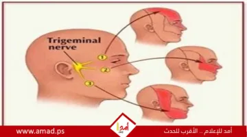 أعراض التهاب العصب الثلاثي التوائم