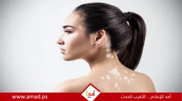 علامات ووسائل التعامل مع حالة البهاق