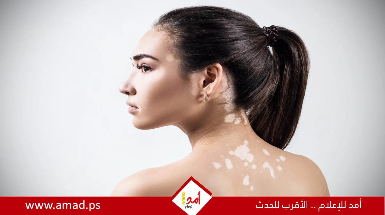 علامات ووسائل التعامل مع حالة البهاق علامات ووسائل التعامل مع حالة البهاق