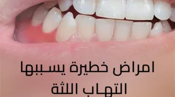 أمراض تهدد الصحة نتيجة التهاب اللثة.. فيديو توضيحي