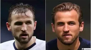 20 صورة لأهم نجوم كرة القدم الذين خضعوا لعمليات زراعة الشعر