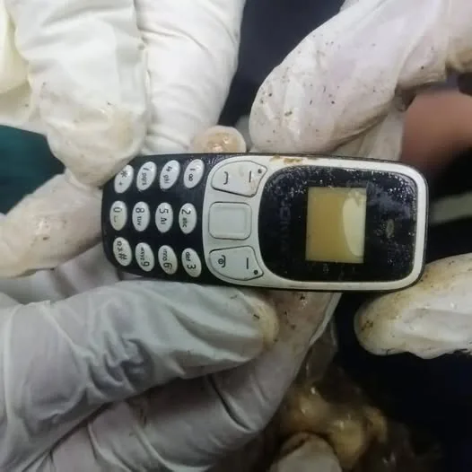 إزالة هاتف محمول من بطن مريض في مستشفى الأزهر الجامعي بأسيوط إزالة هاتف محمول من بطن مريض في مستشفى الأزهر الجامعي بأسيوط