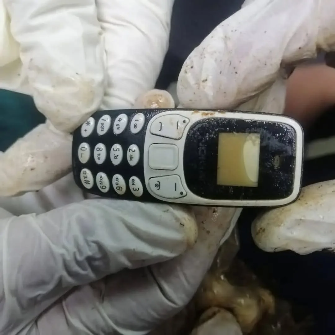 إخراج هاتف محمول من بطن مريض في مستشفى الأزهر الجامعي بأسيوط