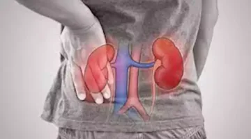 أعراضه تؤذي الجسم بشدة.. لماذا يُطلق على الفشل الكلوي لقب القاتل الصامت؟