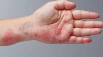 احذر.. زيادة الحرارة تؤدي إلى ظهور طفح جلدي مزعج وخطر على مرضى الإكزيما
