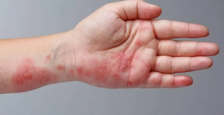 احذر.. زيادة الحرارة تؤدي إلى ظهور طفح جلدي مزعج وخطر على مرضى الإكزيما