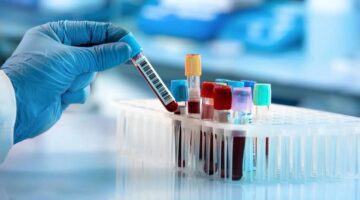 اختبار دم يكشف عن السرطان قبل ظهور العلامات بفترة طويلة