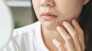 التعرض لزيوت الطبخ يؤدي إلى ظهور بثور على الوجه