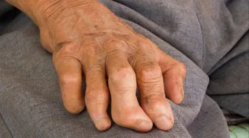 الحكومة تُهيئ لإعلان القضاء على مرض البرص