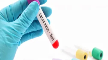 تطوير لقاح مبتكر لمكافحة حمى “لاسا”