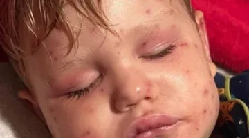 طفل يكافح من أجل البقاء بعد تعرضه لـ150 لدغة من دبابير