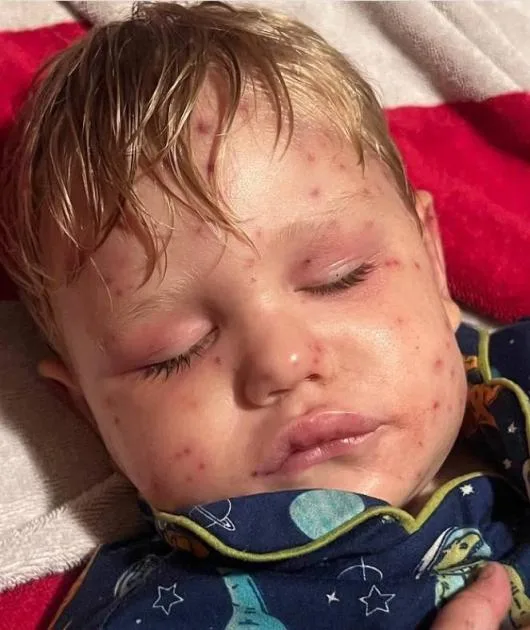 طفل يكافح من أجل البقاء بعد تعرضه لـ150 لدغة من دبابير طفل يكافح من أجل البقاء بعد تعرضه لـ150 لدغة من دبابير