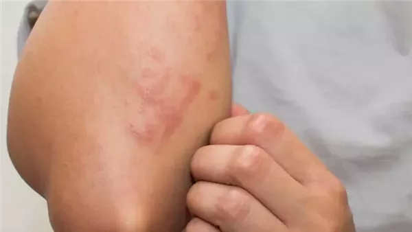 خطأ متكرر خلال الإقامة في الفندق قد يسبب لك الإصابة بالجرب