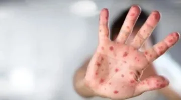 غينيا تُسجِّل 18 حالة جديدة infected بفيروس جدري القرود