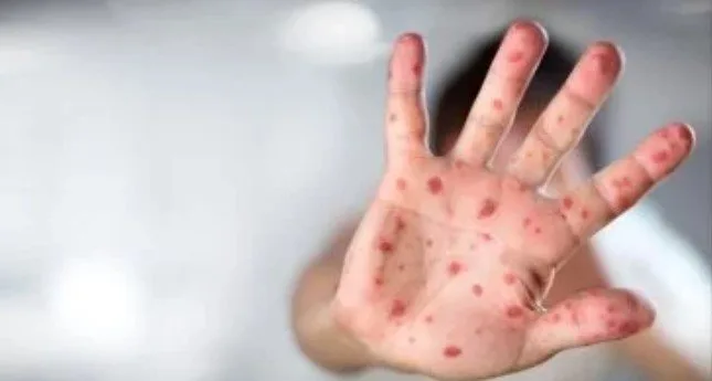 غينيا تُسجِّل 18 حالة جديدة infected بفيروس جدري القرود