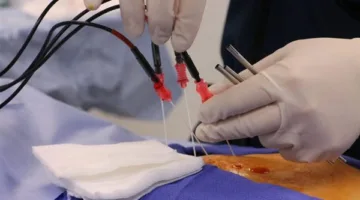 الصحة: فريق مركز ميت غمر ينجح في إزالة ورم نادر من كبد امرأة في الخمسينات من عمرها