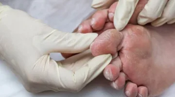 “القدم السكري”: نصائح صحية لتجنب الإصابة به
