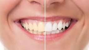 اصفرار الأسنان .. ما أسبابه وما حلوله ؟
