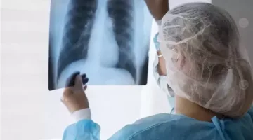 سرطان الرئة يستهدف غير المدخنين أيضاً… والخبراء يناشدون الحذر!