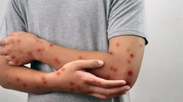 الولايات المتحدة تواجه أعلى معدلات إصابة بالحصبة في 30 عامًا.