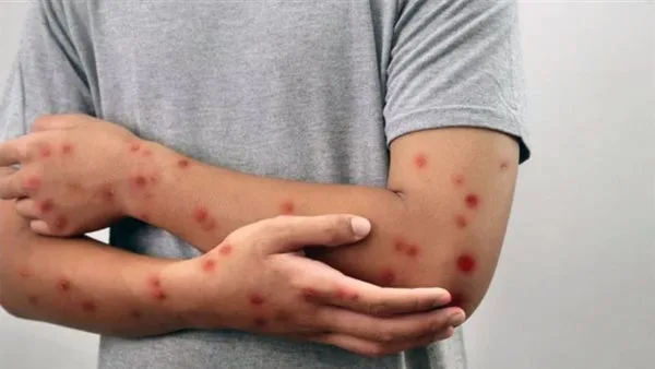 الولايات المتحدة تواجه أعلى معدلات إصابة بالحصبة في 30 عامًا. الولايات المتحدة تواجه أعلى معدلات إصابة بالحصبة في 30 عامًا.