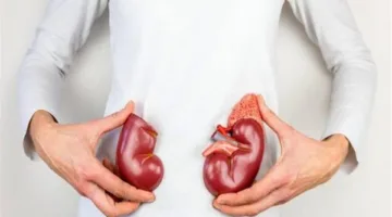 احترس: 3 عوامل تؤدي إلى تكون حصوات الكلى
