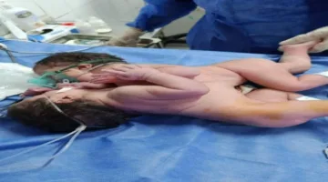 ولادة غير شائعة لتوأم متصل في مستشفى الفيوم العام