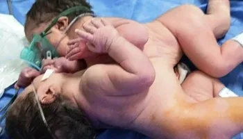 معجزة طبية في الفيوم: ولادة توأم ملتصق في مستشفى عام بحالة نادرة وناجحة