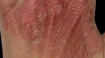 خبز سارة لمرضى الحروق: علاج قد يُعجّل بشفاء جروحكم