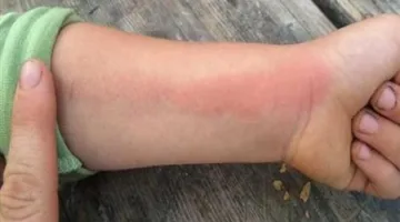 بعد رحيل المخرج سامح عبد العزيز.. ما هي عدوى الدم وما علاماتها؟
