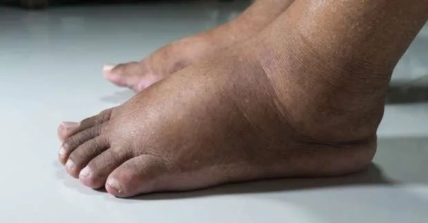 7 علامات على القدمين تشير إلى الإصابة بتليف الكبد 7 علامات على القدمين تشير إلى الإصابة بتليف الكبد