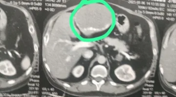 نجاح طبي في مركز أورام طنطا: إزالة ورم دموي كبير من كبد مريض خلال جراحة معقدة