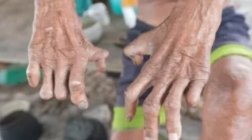وزارة الصحة تقدم علاج الجذام بالمجان في العيادات الجلدية التخصصية في كافة المحافظات.