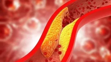 علامات على اليدين تدل على ارتفاع مستويات الكوليسترول في الدم