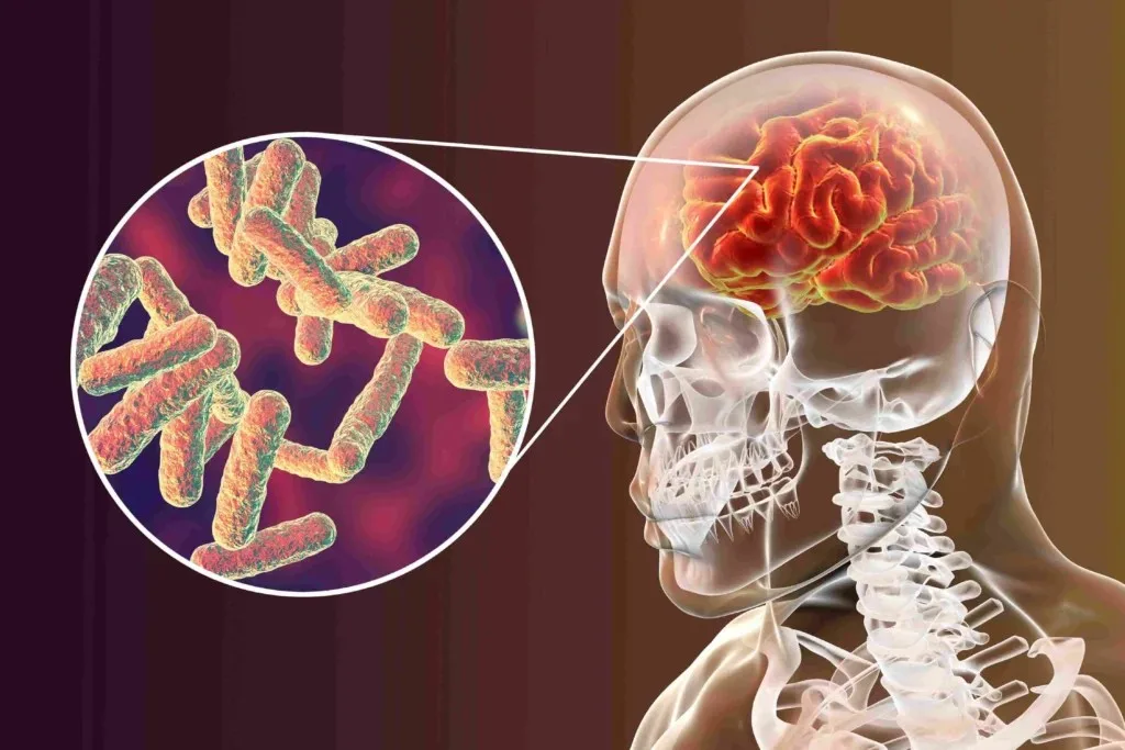 هل مرض الالتهاب السحائي موجود في مصر؟.. تقرير يسلط الضوء على الموضوع