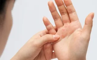 ما الرابط بين الإكزيما وأمراض الكلى المزمنة؟