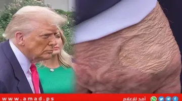 البيت الأبيض يوضح الوضع الصحي لترامب والأورام الموجودة على يديه