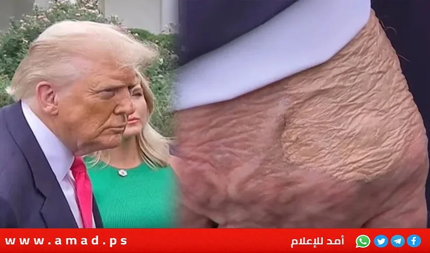 البيت الأبيض يوضح الوضع الصحي لترامب والأورام الموجودة على يديه البيت الأبيض يوضح الوضع الصحي لترامب والأورام الموجودة على يديه
