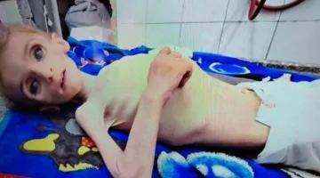 وفاة طفلة فلسطينية جراء نقص التغذية في دير البلح وسط قطاع غزة