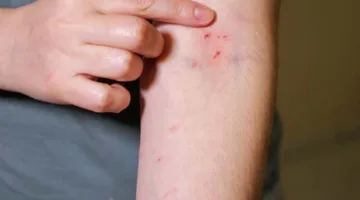 استشاري ينبه: ظهور الحبوب الجلدية يعد مؤشراً على إرهاق الكلى