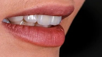 زيركون الأسنان: الخيار الأمثل لابتسامة ساحرة ومشرقة