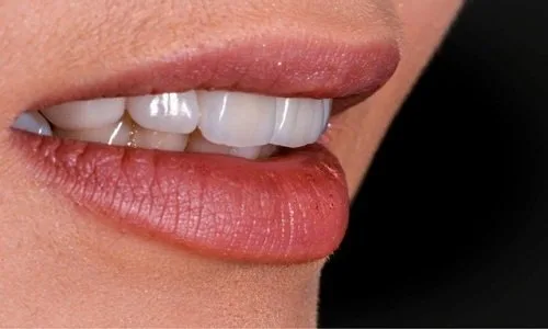 زيركون الأسنان: الخيار الأمثل لابتسامة ساحرة ومشرقة زيركون الأسنان: الخيار الأمثل لابتسامة ساحرة ومشرقة