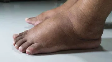 8 مؤشرات على خمول الكبد.. لا تغفل عن هذه العلامات