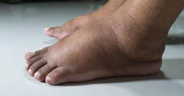 8 مؤشرات على خمول الكبد.. لا تغفل عن هذه العلامات 8 مؤشرات على خمول الكبد.. لا تغفل عن هذه العلامات