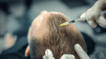 علاج تساقط الشعر باستخدام السائل المنوي