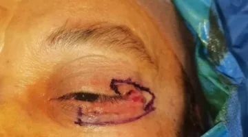 نجاح عملية جراحية معقدة لإزالة ورم سرطاني من الجفن وإعادة بنائه في وحدة تجميل العيون بمستشفى سوهاج الجامعي