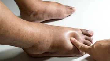 استكشف الأسباب المتنوعة للوذمة