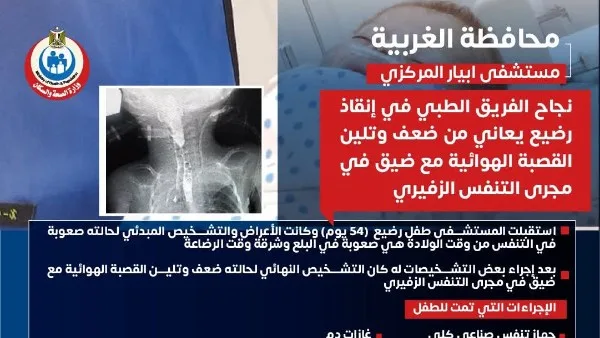 إنقاذ طفل حديث الولادة يعاني من ضعف وتلين في القصبة الهوائية بمستشفى أبيار في الغربية